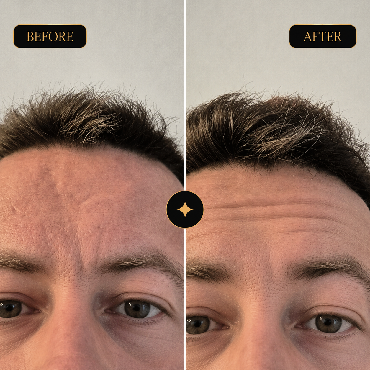 Anti-wrinkle treatment