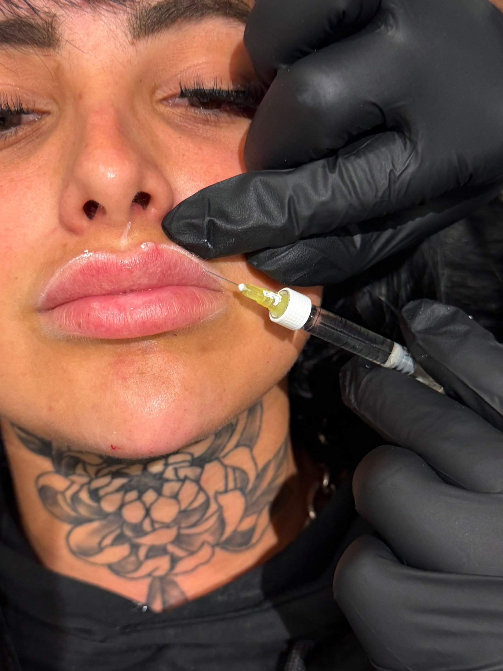 Lip augmentation